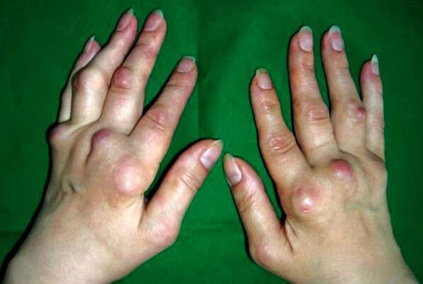 Hands affected by deforming polyosteoarthritis