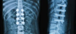 x-rays of the back